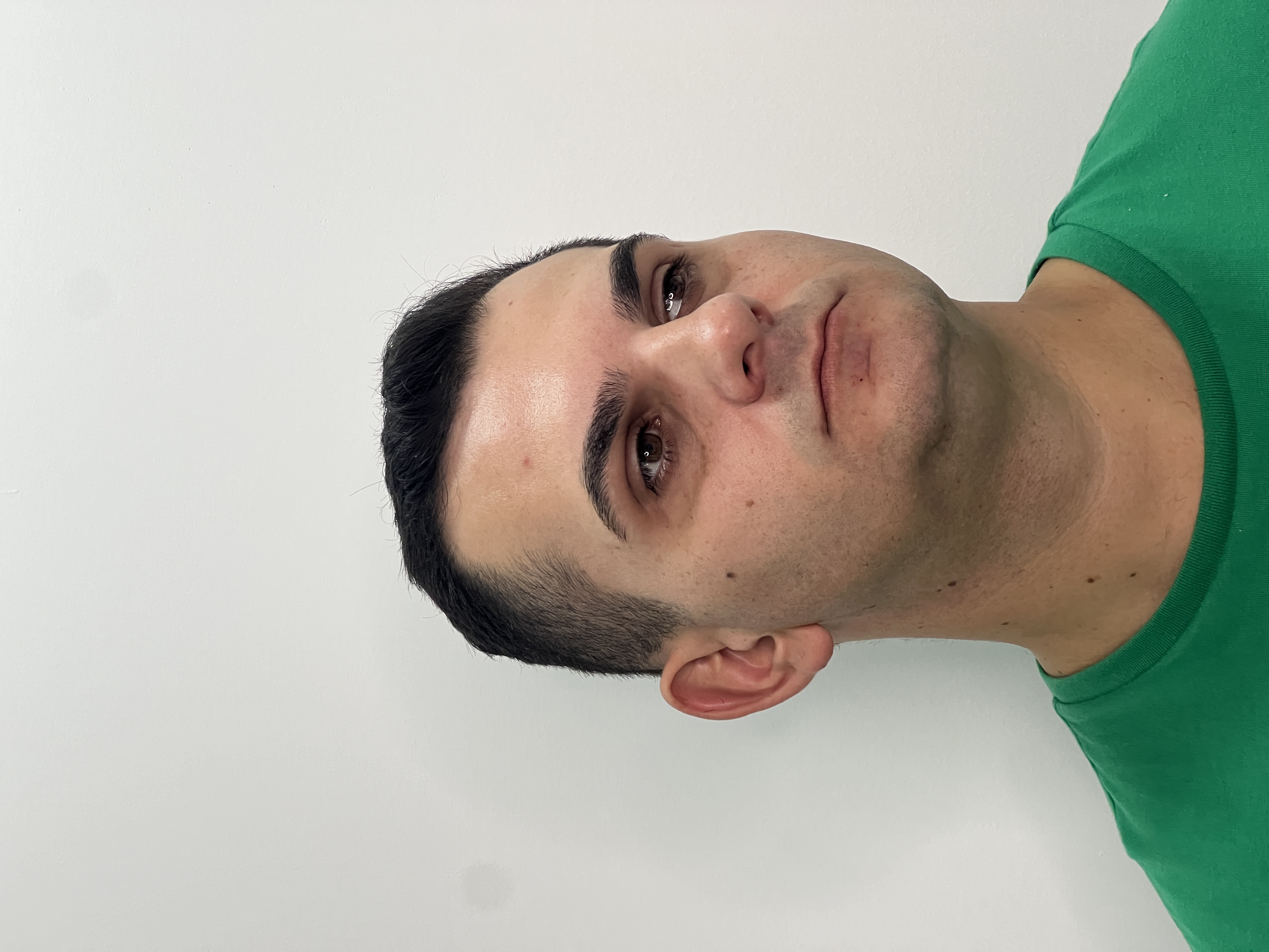 Zéfo antes da harmonização facial - sem barba